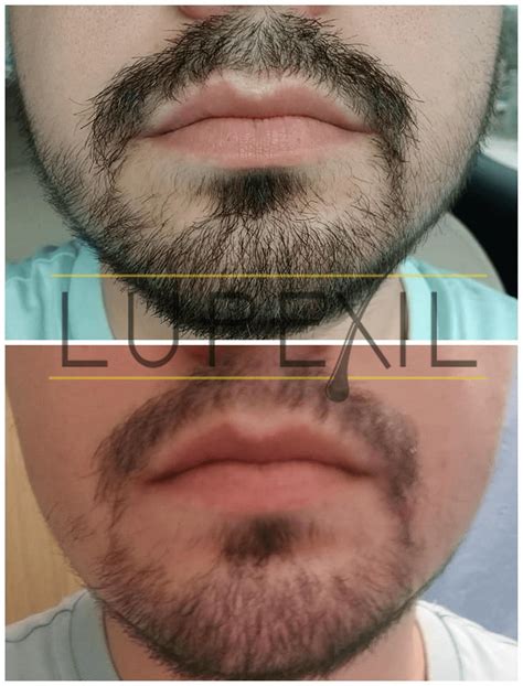 Minoxidil Al Para Barba Y Bigote Lupexil Efectos Secundarios