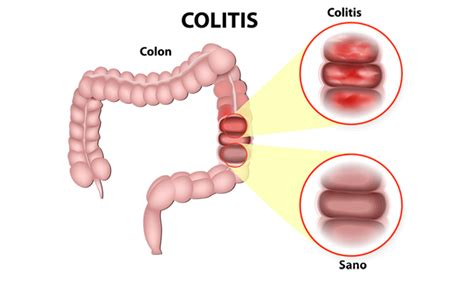 Enfermedad De Crohn Y Colitis Ulcerosa