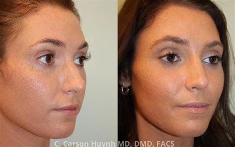 Rhinoplasty Case 3177 Radiance Surgery Aesthetic Medicine