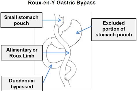 Gastric Bypass Roux En Y Gastric Bypass Indications Side Effects