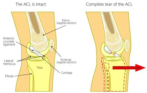 ACL rupture? You have options. - The Healthy Body Company