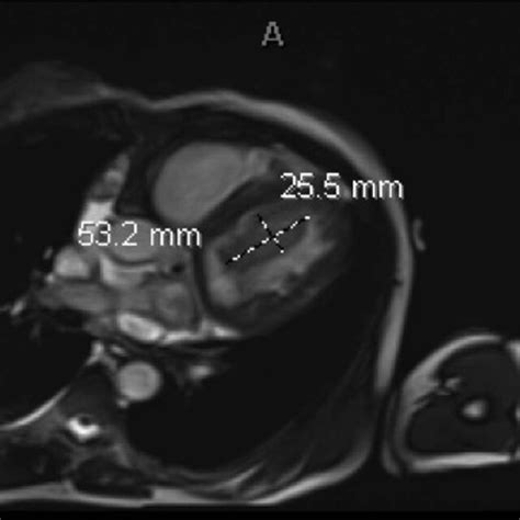 Cardiac Magnetic Resonance Imaging With True Fast Imaging With