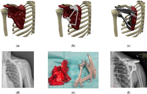 Figure 1 From Computer Assisted Surgery And 3d Printing In Orthopaedic Oncology A Lesson