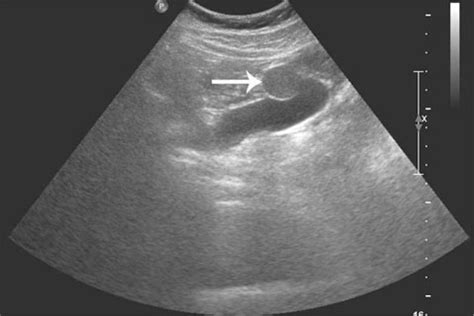 Ciliated Foregut Cyst Of The Gallbladder A Case Report With US And CT