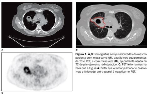 Radiologia Brasileira O Uso De Fdg Pet Tc Scan No Planejamento Da