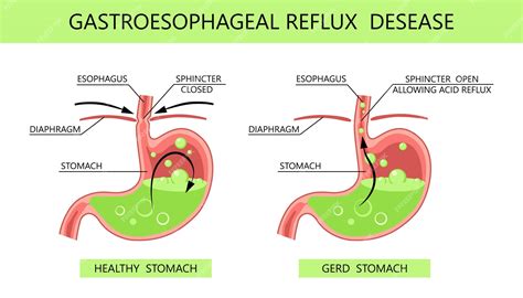 Enfermedad Por Reflujo Gastroesofágico Infografía De Reflujo ácido