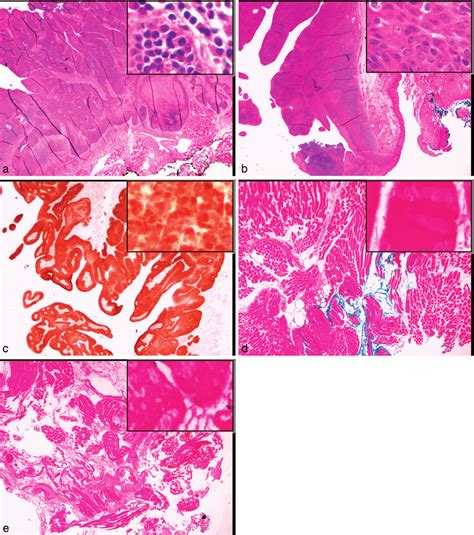 Squamous Cell Carcinoma With Different Margins And P16 Expression By Download Scientific