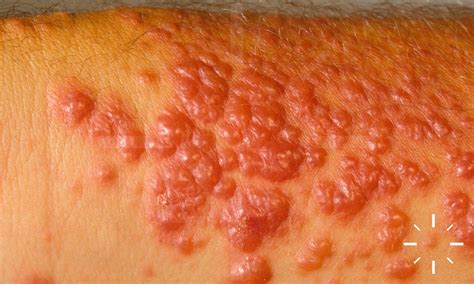 Dermacompass Erythema Exsudativum Multiforme