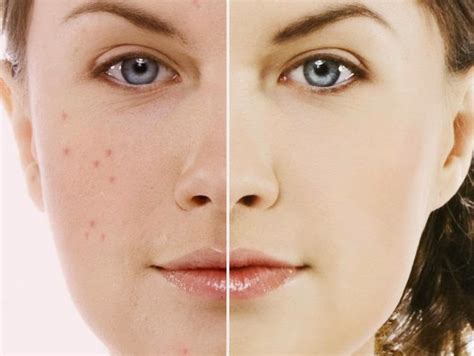 Cystic acne causes and treatments | Benefits and Uses