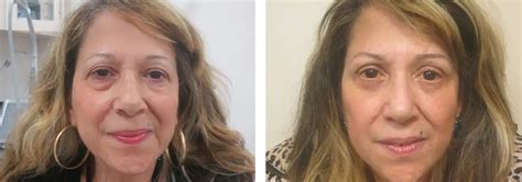 4 Lid Blepharoplasty Before And After Photo Gallery A Rabinovich