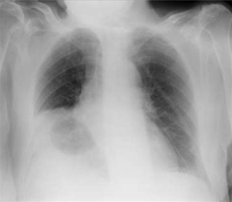 When Pneumonia Becomes A Double Congenital Diaphragmatic Hernia Bmj Case Reports