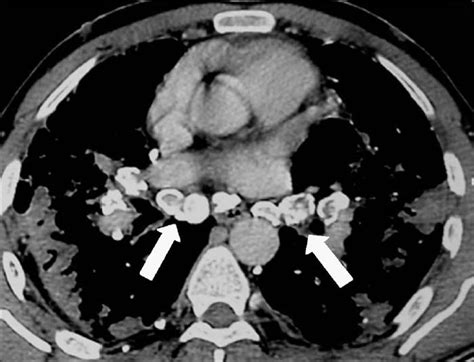 Silicosis Eggshell Calcification