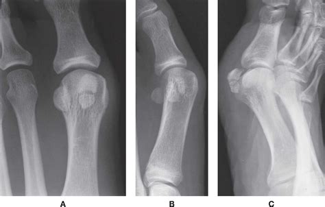 6 Normal Variants And Anomalies Musculoskeletal Key