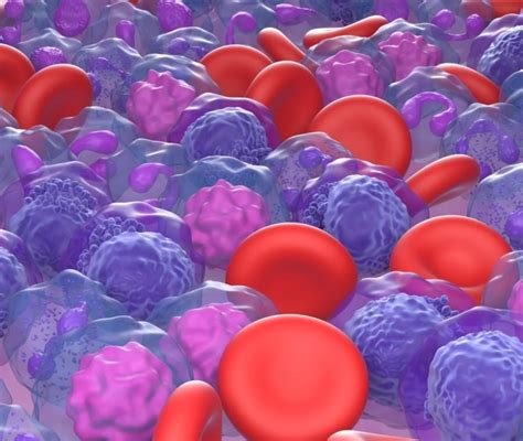 Leucemia Mieloide Acuta Cosè Cause Sintomi e Terapie