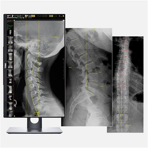 Universal Chiropractic X-Ray System – Raynex X-Ray