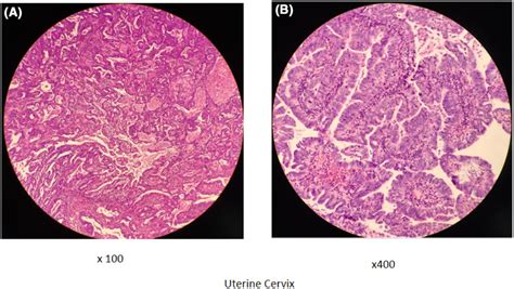 Histology of serous carcinoma of the uterine cervix shows endometrioid ...