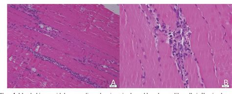 Figure 2 from A case of dermatomyositis with secondary Sjögren s