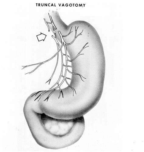 Figure 1 from Selective and highly selective vagotomy with and without ...