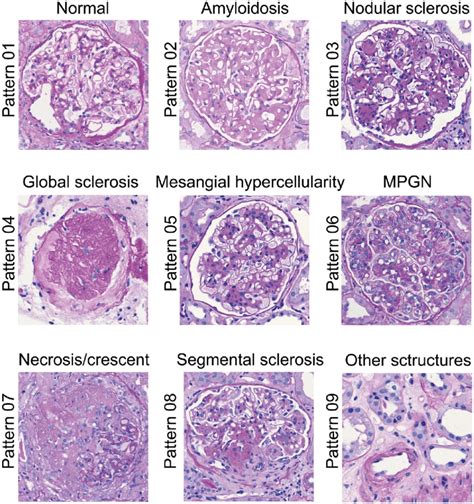 Paradigmatic Patterns Of Glomerular Diseases In Terms Of Conventional