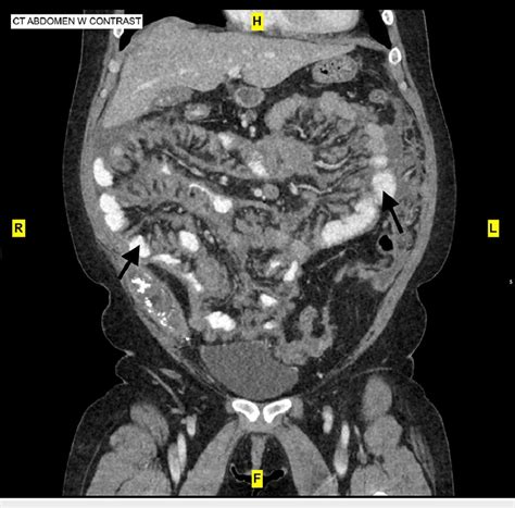 Ct Abdomen With Contrast Showing Peritoneal Nodularity Stranding And Download Scientific