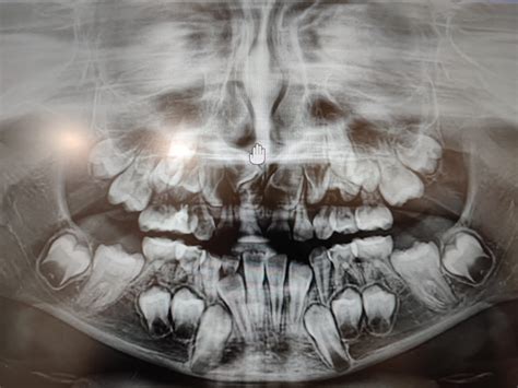 The Importance Of Making X Rays At The Age Of