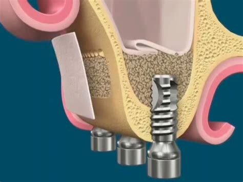 Levantamento Do Seio Maxilar Sinus Lift Alex Albanese Odontologia