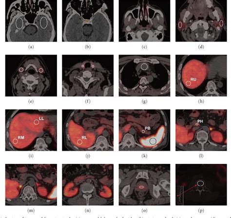 Figure From Dynamic Total Body Pet Ct Imaging Reveals Kinetic