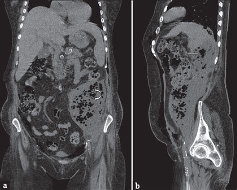 Necrotizing Fasciitis Of Thoracic And Abdominal Wall With Emphysematous Pyelonephritis And