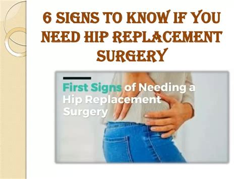 Ppt Signs To Know If You Need Hip Replacement Surgery Powerpoint