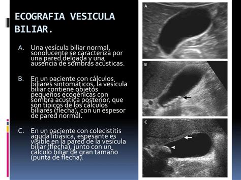 PPT ACTUALIZACION EN EL MANEJO DE LA COLECISTITIS AGUDA PowerPoint