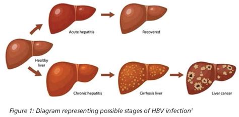 Chronic Hepatitis B Virus Hbv University Hospitals Sussex Nhs