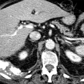 Coronal A And Axial B Contrast Enhanced Ct One Month Later Shows