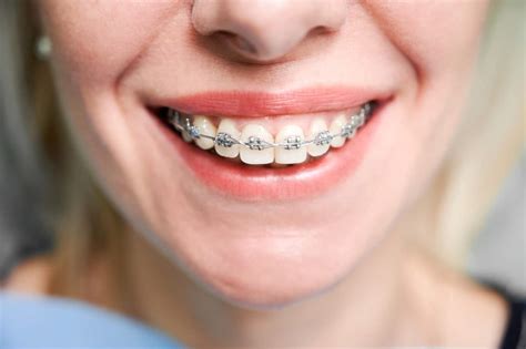 How Do Braces Work Bracesetters