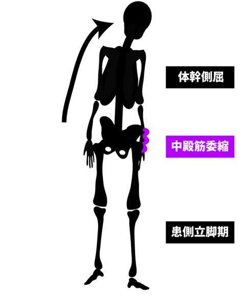 変形性股関節症に伴う姿勢変化や異常歩行の原因