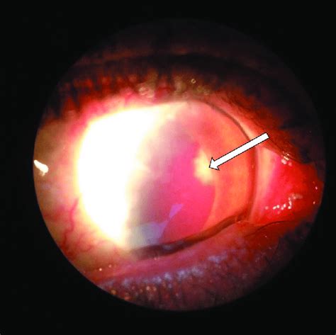 Slit lamp photograph of the right eye showing aphakia and a ball of... | Download Scientific Diagram