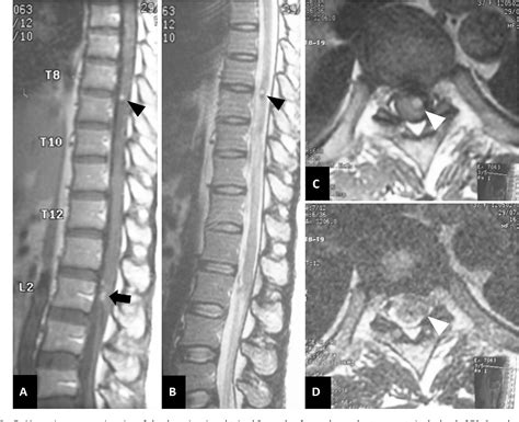 Figure From Remote Intramedullary Hemorrhage In The Thoracic Spinal