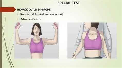 Thoracic Outlet Syndrome Sk Physio Bd