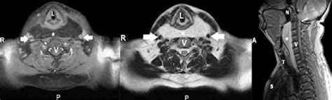 Preoperative Magnetic Resonance Imaging Scans A T 1 Weighted Axial