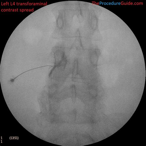 Intraforaminal Epidural Steroid Injection - mapametawan