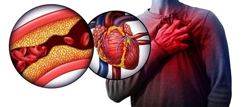 Cardiac Arrest Vs Heart Attack Know The Difference Safety And Health