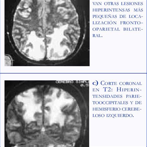 RESONANCIA MAGN TICA DE CEREBRO SIMPLE DE PACIENTE DE 16 A OS CON