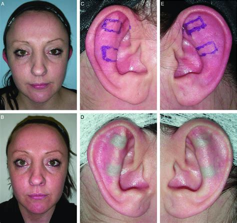 A Year Old Female Patient Who Underwent Standard Otoplasty As A