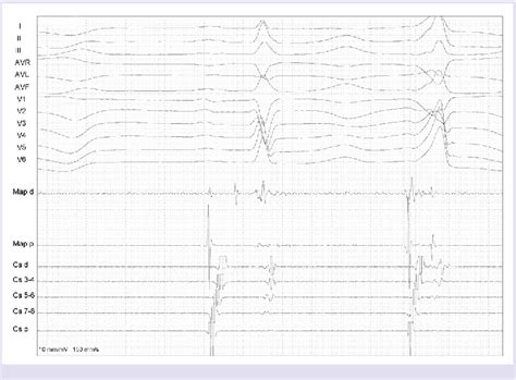 Figure From Catheter Ablation Of Para Hisian Premature Ventricular