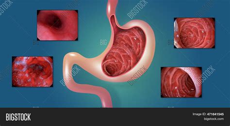 Gastric Mucosa Image And Photo Free Trial Bigstock