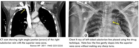 Pulmcrit Shrug Technique For Us Guided Subclavian Lines