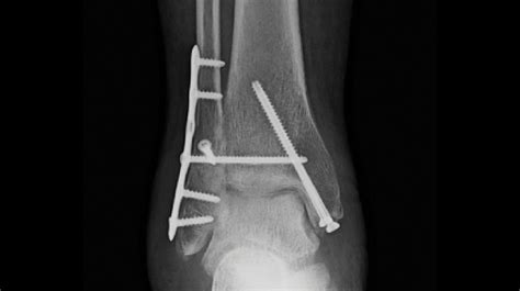 Whats New In Podiatry Journal Article Summary Factors Associated