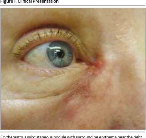 Figure 1 From Mycobacterium Mucogenicum Infection Following Dacryocystorhinostomy And Crawford