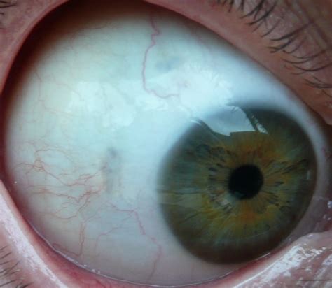 red spot on eyelid - pictures, photos