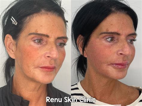 THREAD LIFT Renu Skin Clinic Thread Lift Dundee Neck Lift Dundee