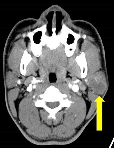 Pleomorphic Adenoma Mri